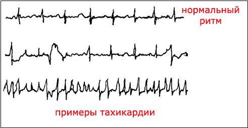Тахикардия