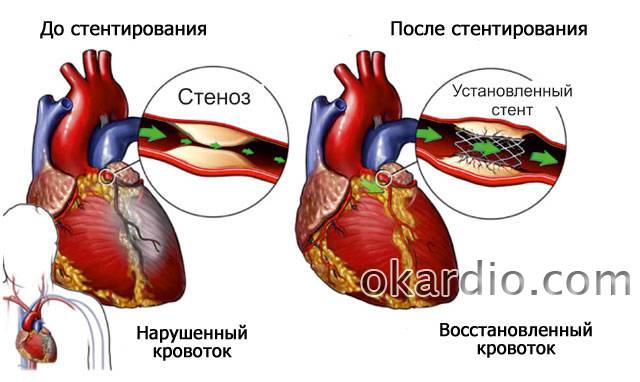 стентирование коронарных сосудов сердца