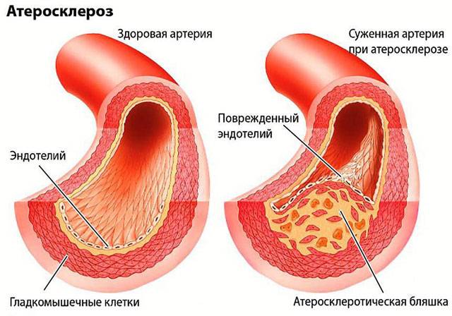 атеросклероз поврежденных артерий