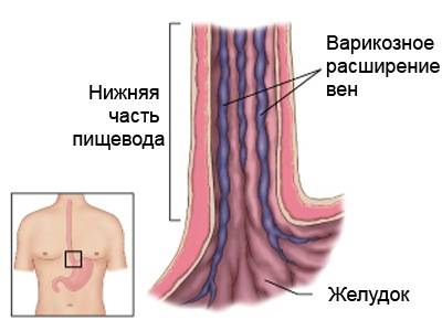 варикозное расширение вен пищевода
