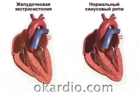 желудочковая экстрасистолия