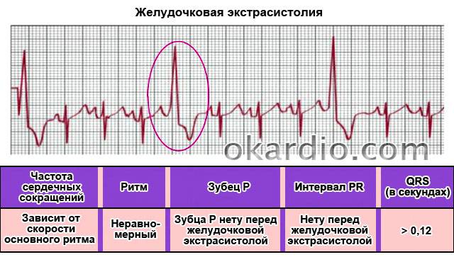 желудочковая экстрасистолия на ЭКГ
