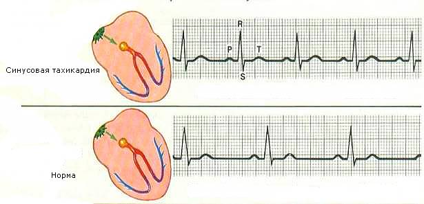 Синусовая тахикардия при беременности