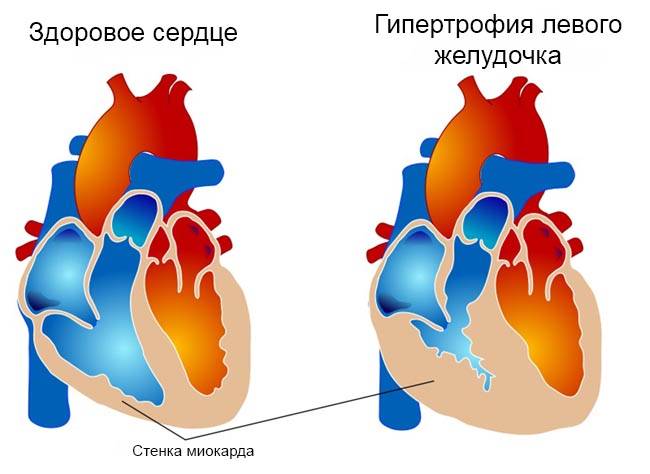 Гипертрофия левого желудочка
