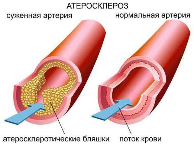 Атеросклероз