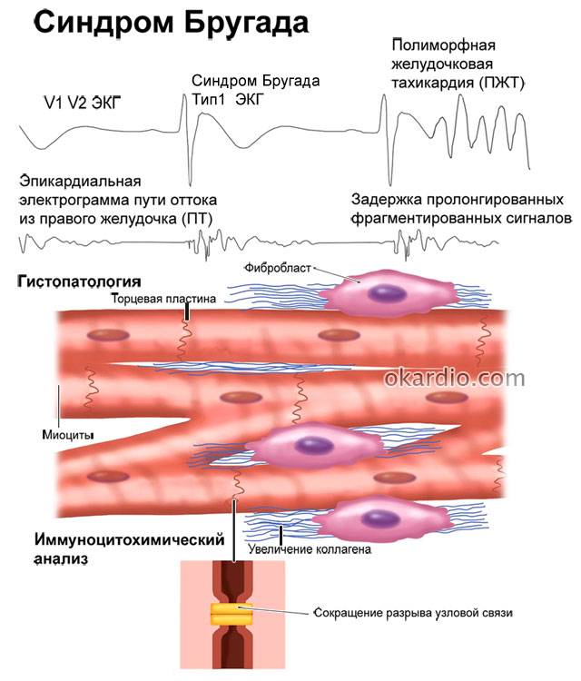 синдром Бругада