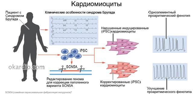 кардиомиоциты при синдроме Бругада