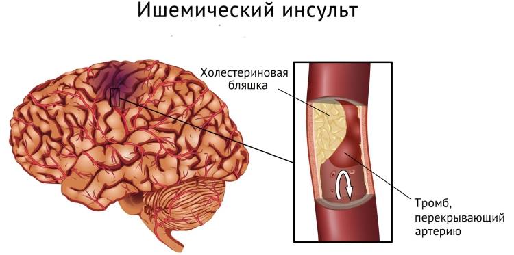 Ишемическая форма