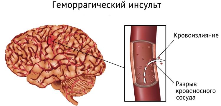 Геморрагическая форма
