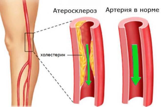 Образование холестериновых бляшек в кровеносных сосудах