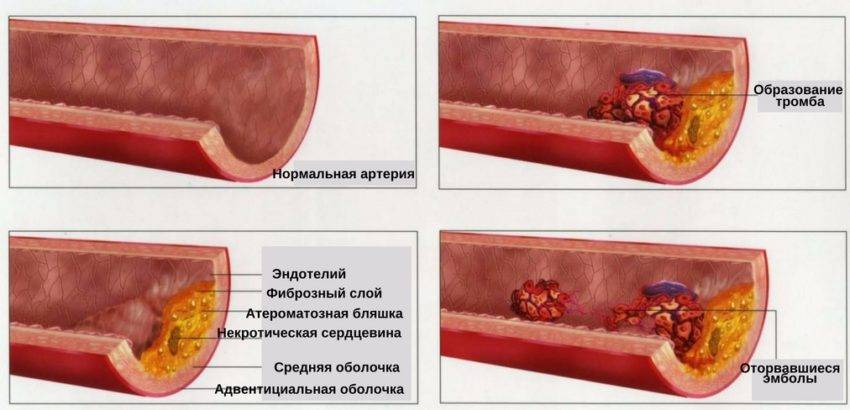 чем опасно развитие атеросклероза