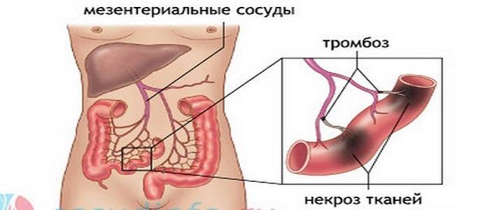 Некроз кишечника