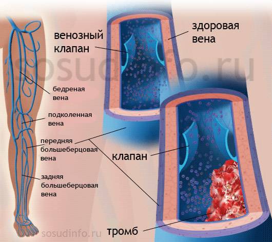 тромбофлебит