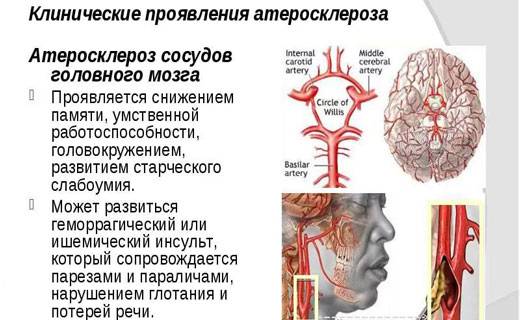 атеросклероз