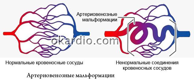 артериовенозные мальформации