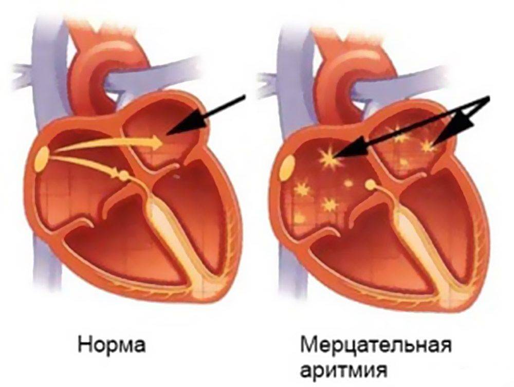 Аритмия симптомы лечение