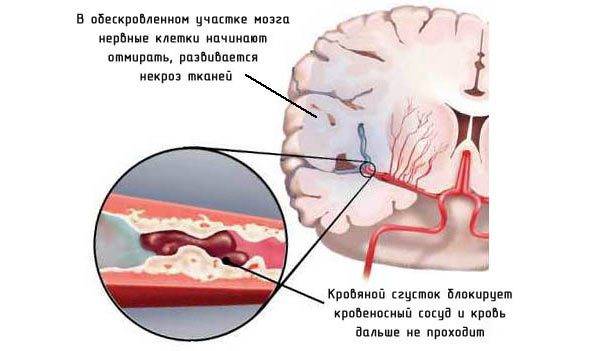 Тромб блокирует сосуд в головном мозге