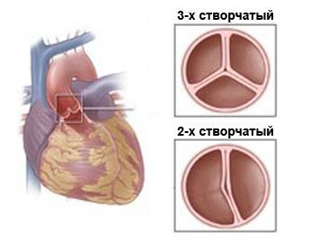 Единственный желудочек сердца3