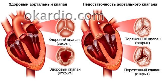 недостаточность аортального клапана