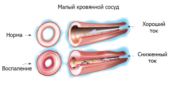 Васкулит причины