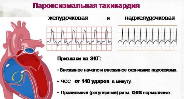 классы тахикардии