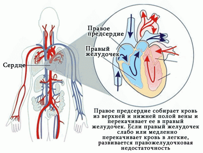 Острая сердечная недостаточность