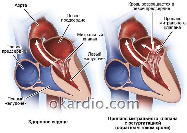 пролапс митрального клапана