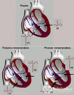 Стадии гипертрофии правого желудочка