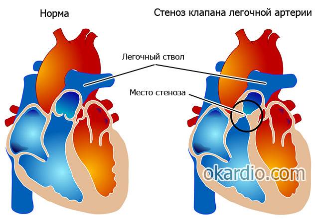 стеноз легочного клапана