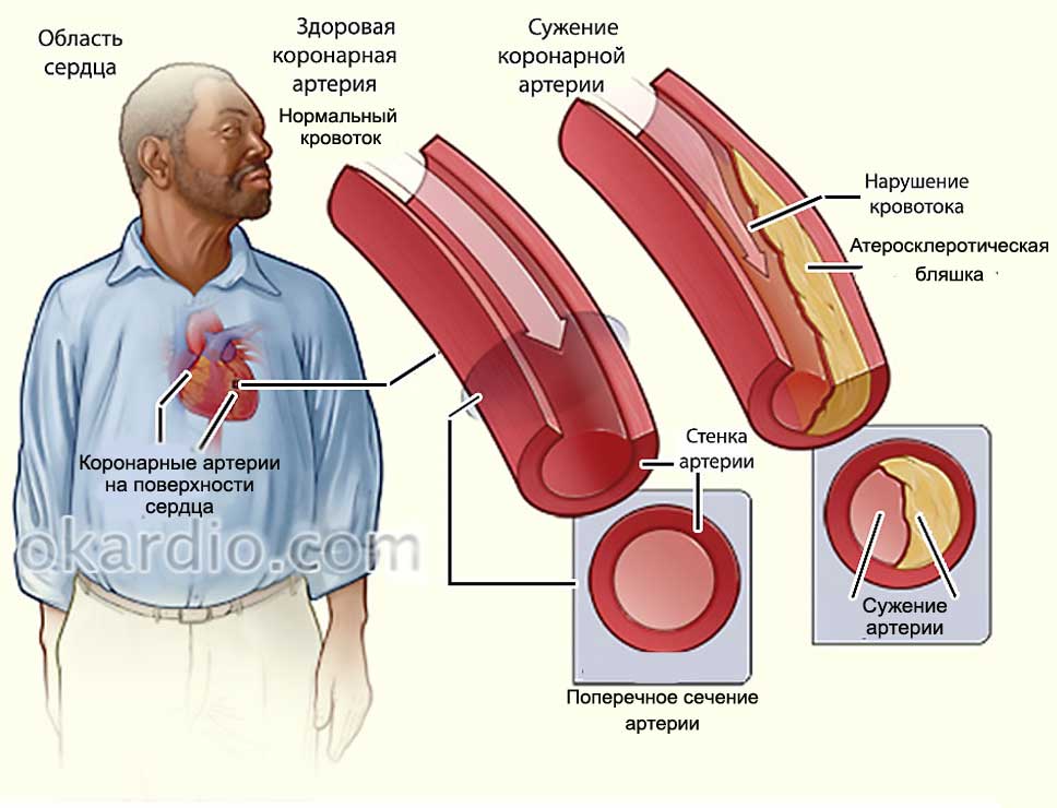 нормальный сосуд и пораженный сосуд