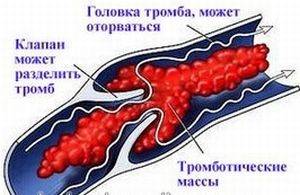 как возникает тромб
