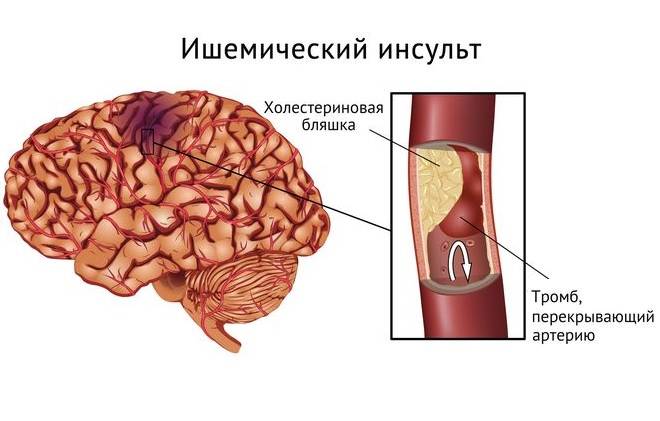 Плохой холестерин в сосудах головного мозга делает закупорку и тромбоз