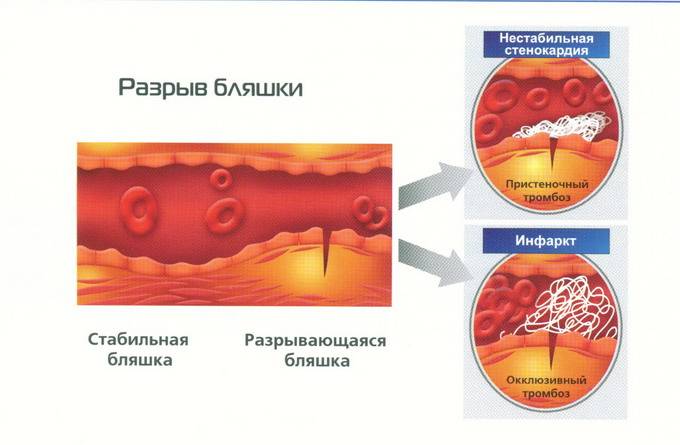 Проявление нестабильной стенокардии