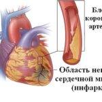 Признаки ишемии сердца у женщин
