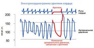 Проявления аритмии хорошо показывает ЭКГ