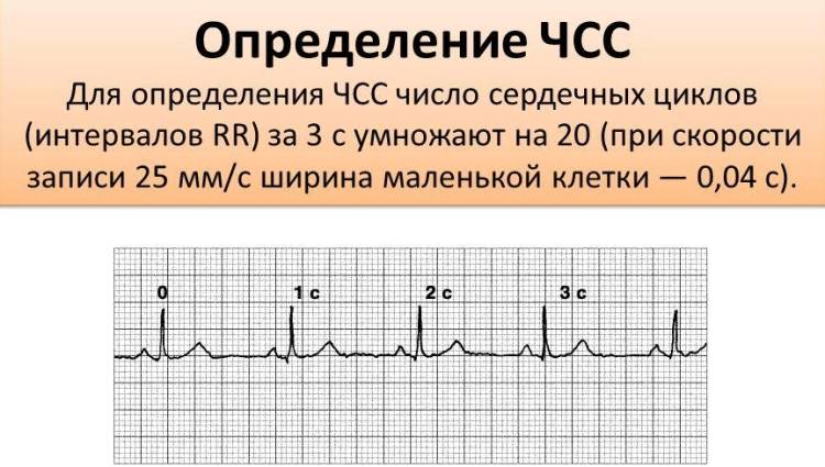 Показатели ЧСС на кардиограмме