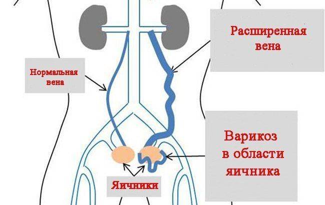 Варикоз малого таза