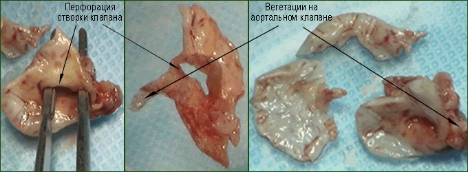 Инфекционный эндокардит (фото)