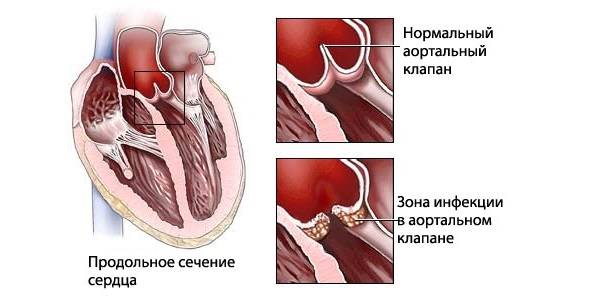 Инфекционный эндокардит в аортальном клапане