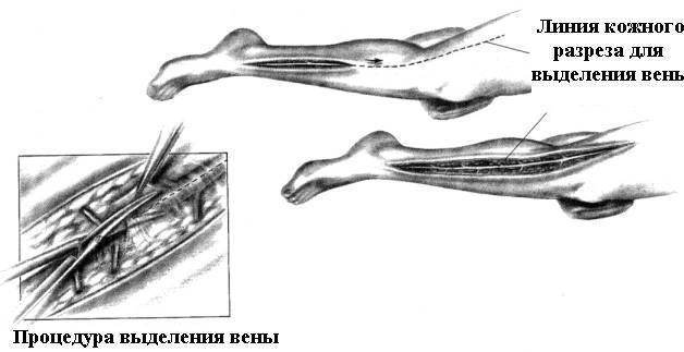 Коронарное шунтирование сердца