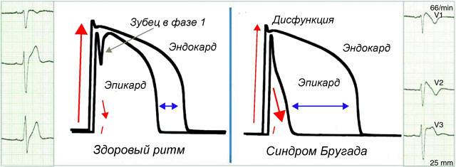 синдром Бругада на ЭКГ