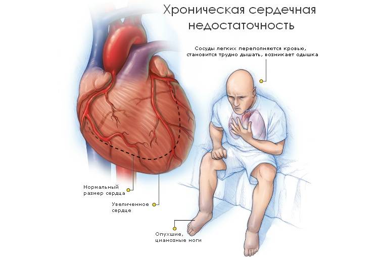 Сердечная одышка