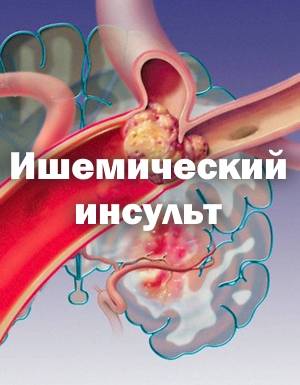 Ишемический инсульт