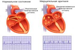 Схема мерцательной аритмии