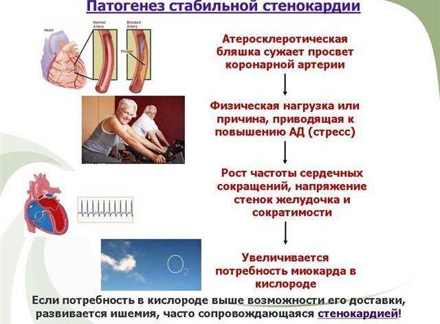 Что такое стенокардия