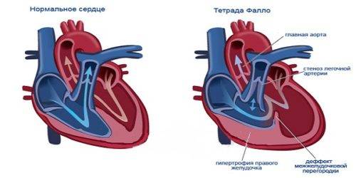 porok-serdca-u-rebenka-simptomy.jpg