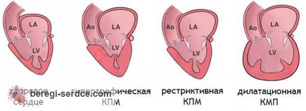Первичный вид кардиомиопатий Первичный вид кардиомиопатий