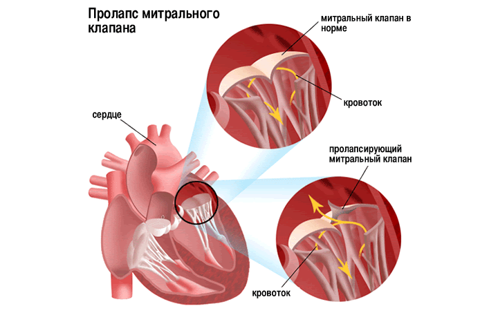 Пролапс митрального