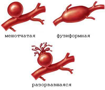 виды аневризмы