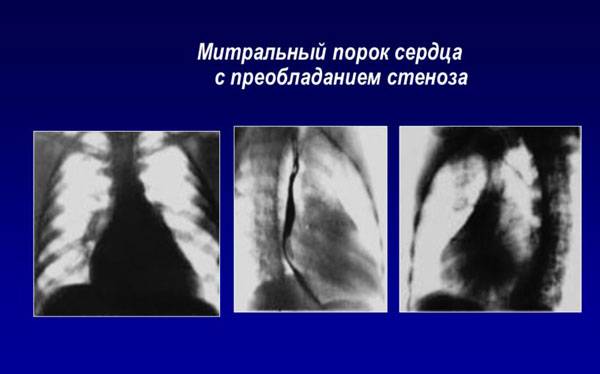 Митральный порок с преобладанием стеноза